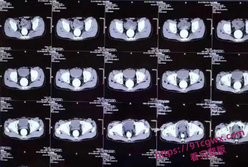 吉林大学三院刘俊志副院长与护士长杨依玲玩SM 药嗑多了往逼里疯狂塞假鸡吧 护士长被玩到直肠穿孔人没了-13